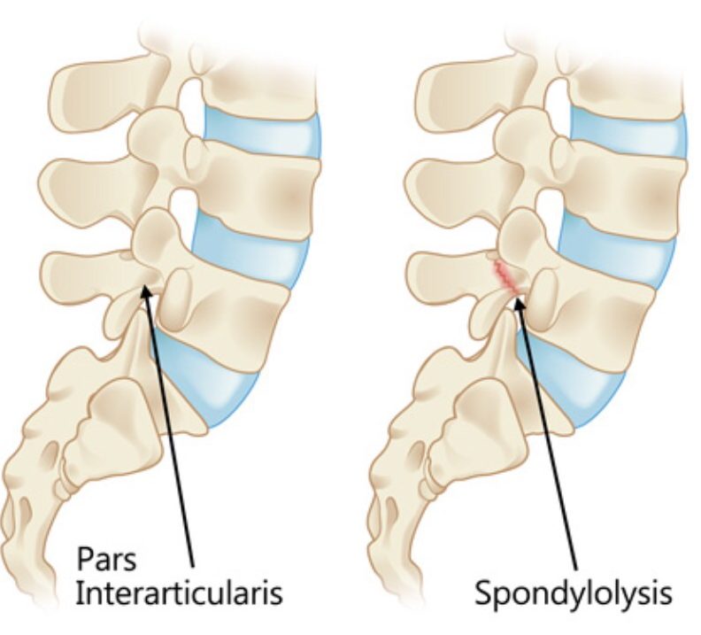 Back Stress Fractures